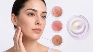 آزالائک اسید برای جوش و لک