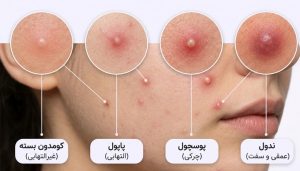 تقاوت کمدون بسته،پاپول،پوسچول و ندول در جوش زیر پوستی